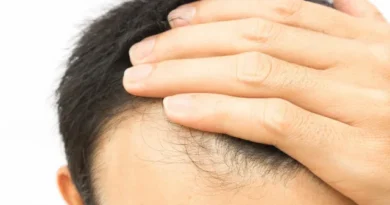 Cabelo transplantado pode cair? Veja alguns detalhes sobre o procedimento